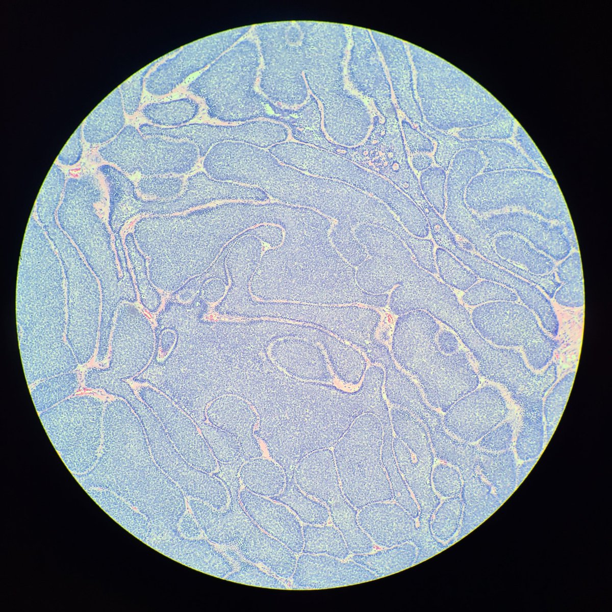 HibTheSlider's tweet photo. Cylindroma
• H&N regions
• Benign adnexal tumour
• Basaloid hyperplasia
• 🧩appearance
• Hyaline membranes and droplets
#pathresidents #beautyinbenign #pathtwitter #dermopath https://t.co/mtDlE6amtD