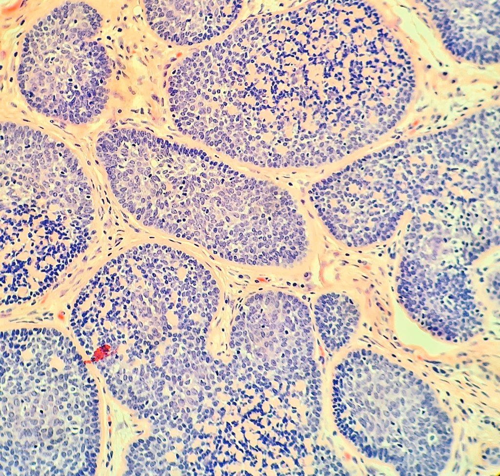 HibTheSlider's tweet photo. Cylindroma
• H&N regions
• Benign adnexal tumour
• Basaloid hyperplasia
• 🧩appearance
• Hyaline membranes and droplets
#pathresidents #beautyinbenign #pathtwitter #dermopath https://t.co/mtDlE6amtD