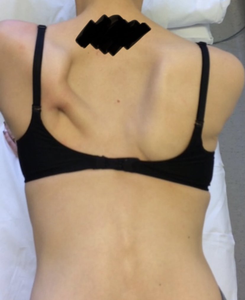 So there’s the Triangle Sign…the Active Elevation Lag Sign…the Scapula Flip Sign…now what about the “Rhomboid-Rope sign” in 4 point kneeling?👇 Any takers? Something I see present in patients with SAN but not LTN palsies…💭