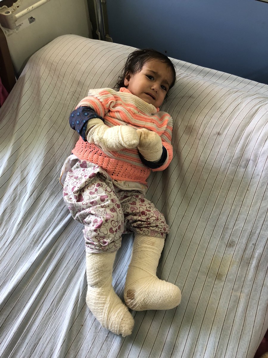 AlexCrawfordSky's tweet photo. For those who contacted @skynews offering to help little Aisha, good news. Literally dozens offered to pay for her bandages and surgery. Enough was raised to cover her costs plus all seven other badly burned children in the ward #Afghanistan https://t.co/N4T9FH8eyL