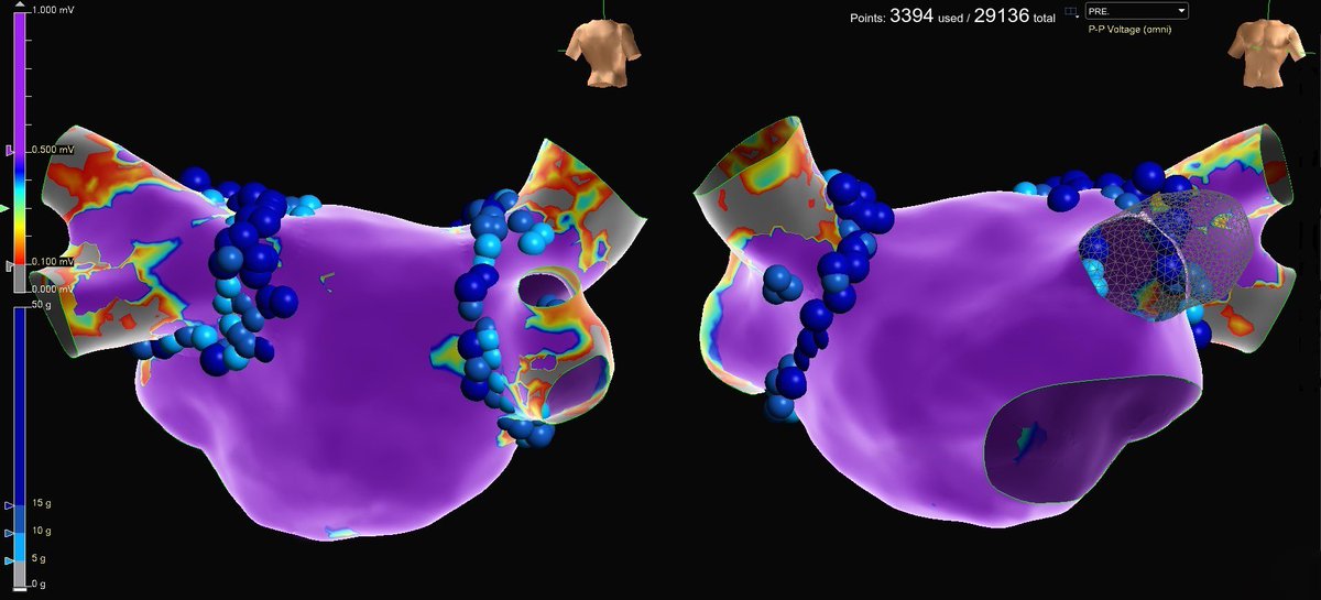 UTHEPHEART's tweet photo. Dr. Sharma performed the first Pulmonary Vein Isoloation #PVI case by @UTHEPHEART @memorialhermann @UTHealthHouston using the #EnSiteX mapping system, using VoXel mode. Images display voltage pre and post ablation. @SamSharmaEPHrt https://t.co/1LO03tn2CU