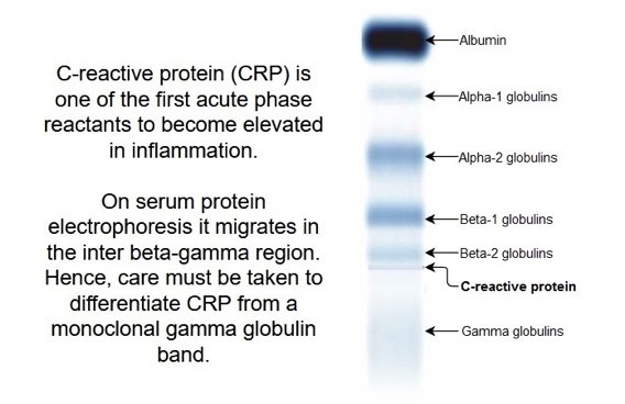 Warrin Booker (@warrin_booker) on Twitter photo Thank you, <a href="/DocMaggiore/">Dr Jack Maggiore</a>, for pointing out how “cytokine storm” of COVID 19 can be misinterpreted as an M spike. #pathElective #twitterHomework Thank you, <a href="/DocMaggiore/">Dr Jack Maggiore</a>, for pointing out how “cytokine storm” of COVID 19 can be misinterpreted as an M spike. #pathElective #twitterHomework