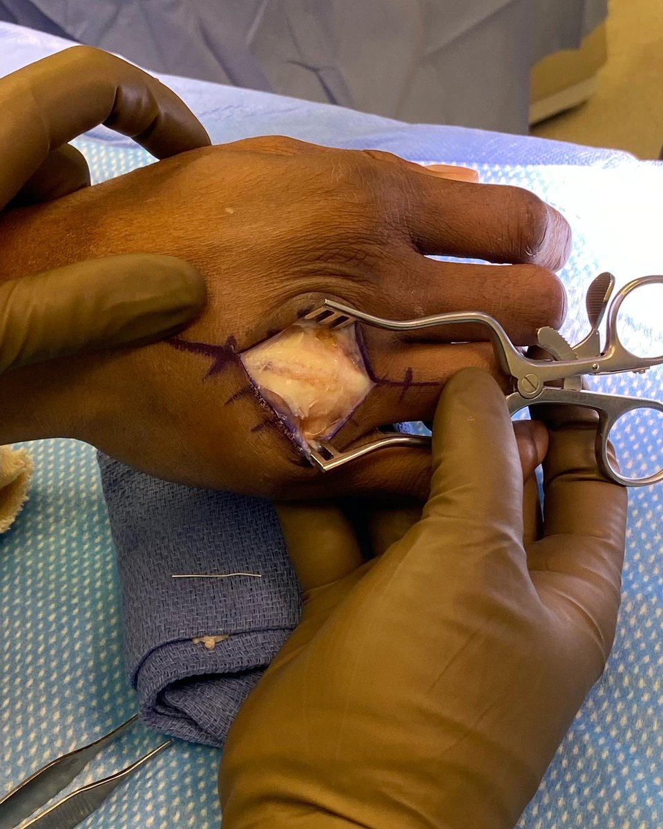 Pound for pound best fighter in the world <a href="/USMAN84kg/">KAMARU USMAN</a> had hand ligament surgery today. This is the before and after. See you soon CHAMP