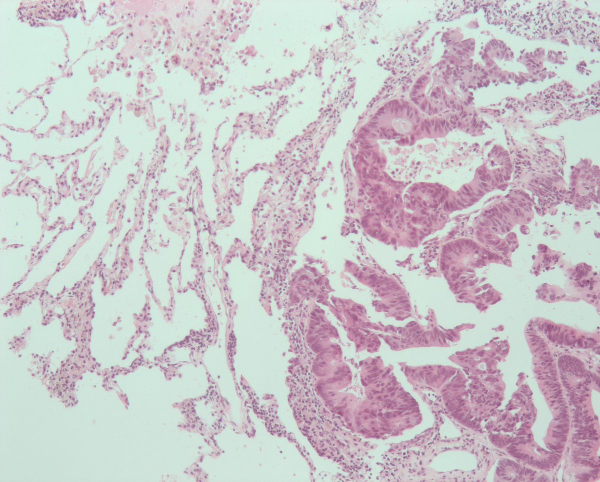 IAP_AUS's tweet photo. ⚕️Diagnosis:
🔬TTF-1 positive metastatic rectal carcinoma
(patient had resection 5 years previously)
#GITpath #IHCpath https://t.co/yxkvb2D4IJ