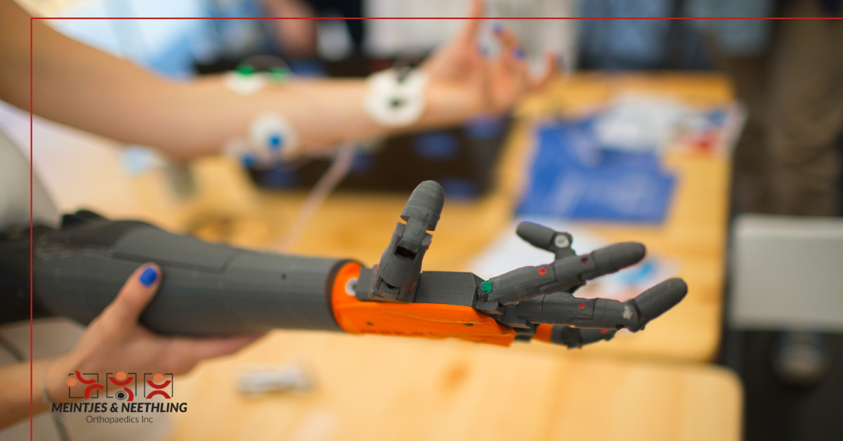 Upper limb prosthesis are intended to restore the function and appearance of missing upper limbs to the greatest extent possible. When we fit our patients with prostheses, we aim to help them compensate for the loss of physical functions. View more: mnortho.co.za/prosthetics/up…