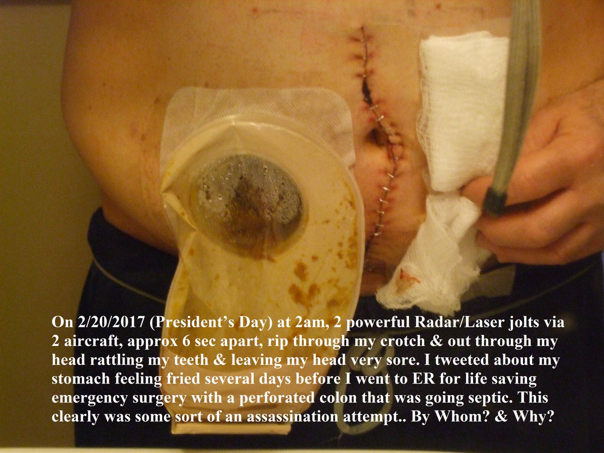 wheeloffreedom1's tweet photo. FTR: The month of February has been a violent month for energy weapon attacks. Last year on 2/11/21, I was hit by a powerful electrical pulse that crippled me at work, followed by a C-130 tree top, on 2/14/21, I was hit again &amp; hospitalized w/ ruptured disc..
on 2/20/2017 THIS ⬇️ https://t.co/lmiBMvlnyw