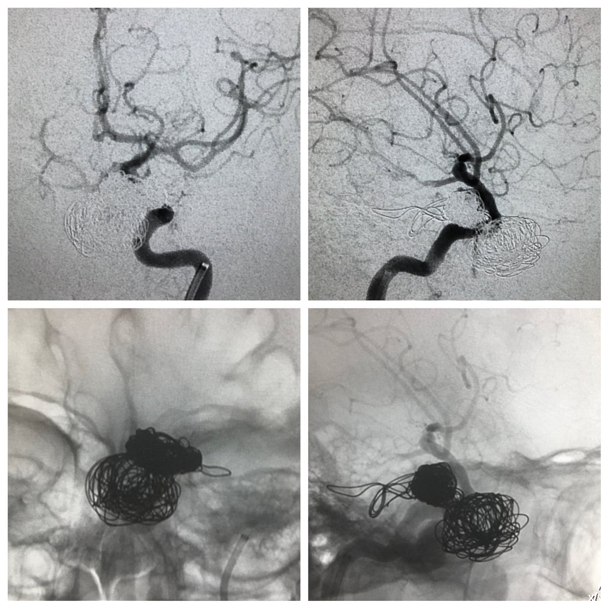 Massive epistaxis after head trauma. No ophalmic symptoms. Embolization w coils and carotid reconstruction w flow diverter. #uncommoncases