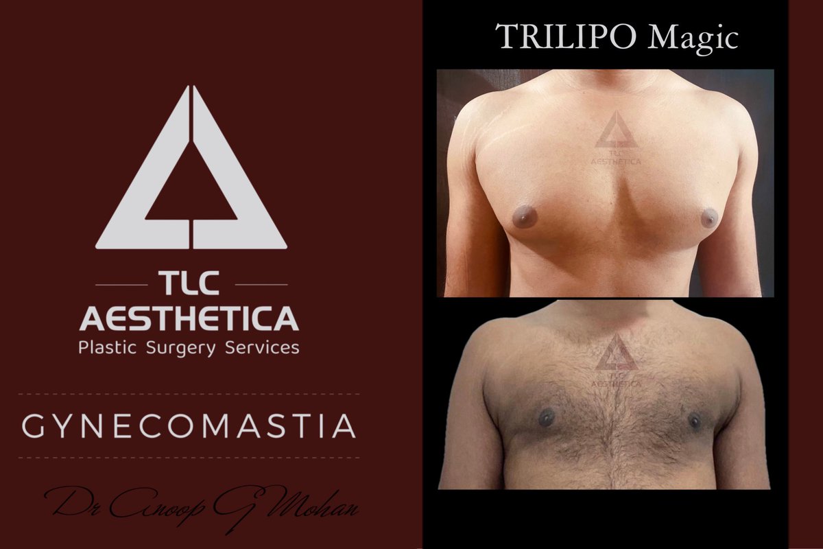 TlcAesthetica's tweet photo. Is this the same person? 
Hard to tell you would need to follow the stretch marks!
That’s is TRILIPO, scarless fussless wonder!
Patient results 50 days after procedure.

#gynecomastia #gynecomastiasurgery #malebreastreduction #malechestreduction #surgery #manboobs #malebreast https://t.co/c9VG0cnI1A