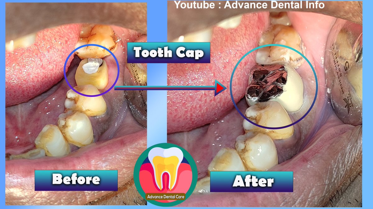Tooth Crown 
#OscarNoms #MewBDayConcert #nhk_jsclub #KiligMatchDonbelle #tuesdayvibe #tuesdayvibe #Dune #Yuzuru #OlympicGames #TheBachelor #YuzuruHanyu