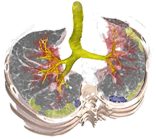 OSICild's tweet photo. Today we demonstrate the value of the #OSICDataRepository in the fight against #ILDs, with #OSICild member @Brainomix announcing the development of a new #AI-powered imaging biomarker that can predict disease progression. https://t.co/wQymqkZP6r #IPF #imaging https://t.co/LjcVGSIpmM