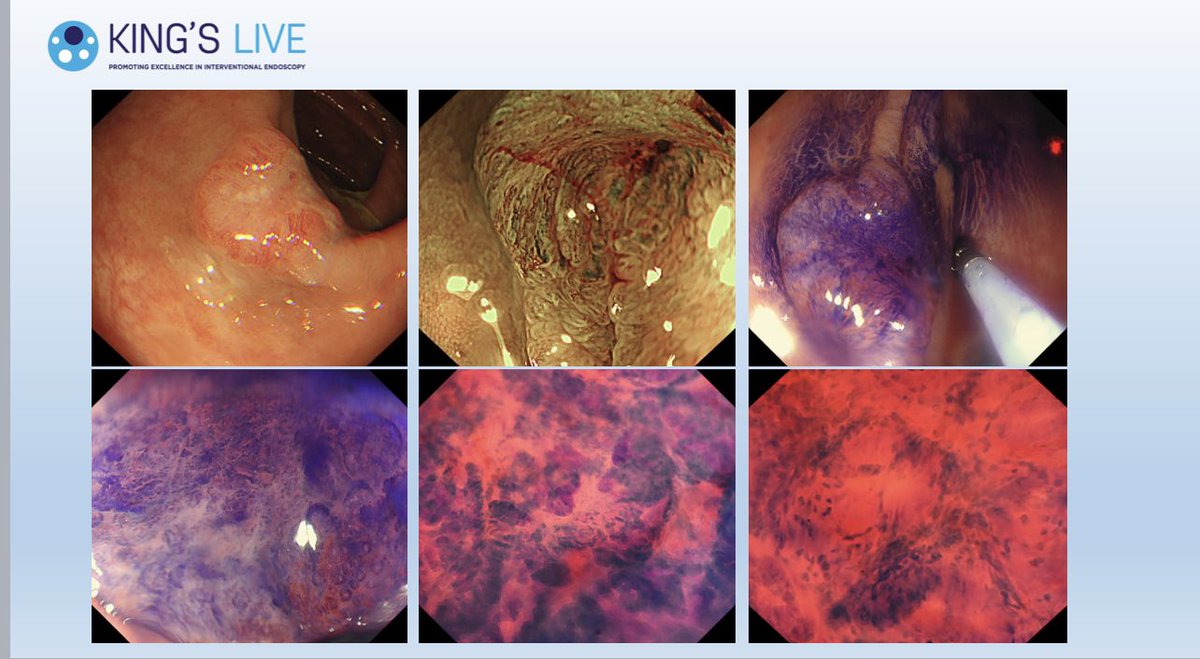 Amyn Haji (@hajiamyn) on Twitter photo Want to learn about getting magnification images of colorectal polyps. Join tomorrow <a href="/kingslivelondon/">King's Live</a> <a href="/DrBuHayee/">Feline_stockholm_syndrome</a> <a href="/BritSocGastro/">BSG</a>
bit.ly/3HEeJu0 Want to learn about getting magnification images of colorectal polyps. Join tomorrow <a href="/kingslivelondon/">King's Live</a> <a href="/DrBuHayee/">Feline_stockholm_syndrome</a> <a href="/BritSocGastro/">BSG</a>
bit.ly/3HEeJu0
