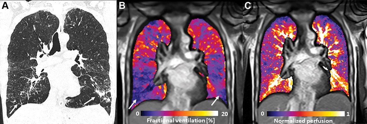 Images in #RADIOLOGY:  Sophisticated lung ventilation and perfusion at low field #MRI (0.55T) with CT correlation.  From <a href="/UniSpitalBasel/">UniSpitalBaselCH</a>  bit.ly/3LifcV2 <a href="/radiology_rsna/">Radiology</a>