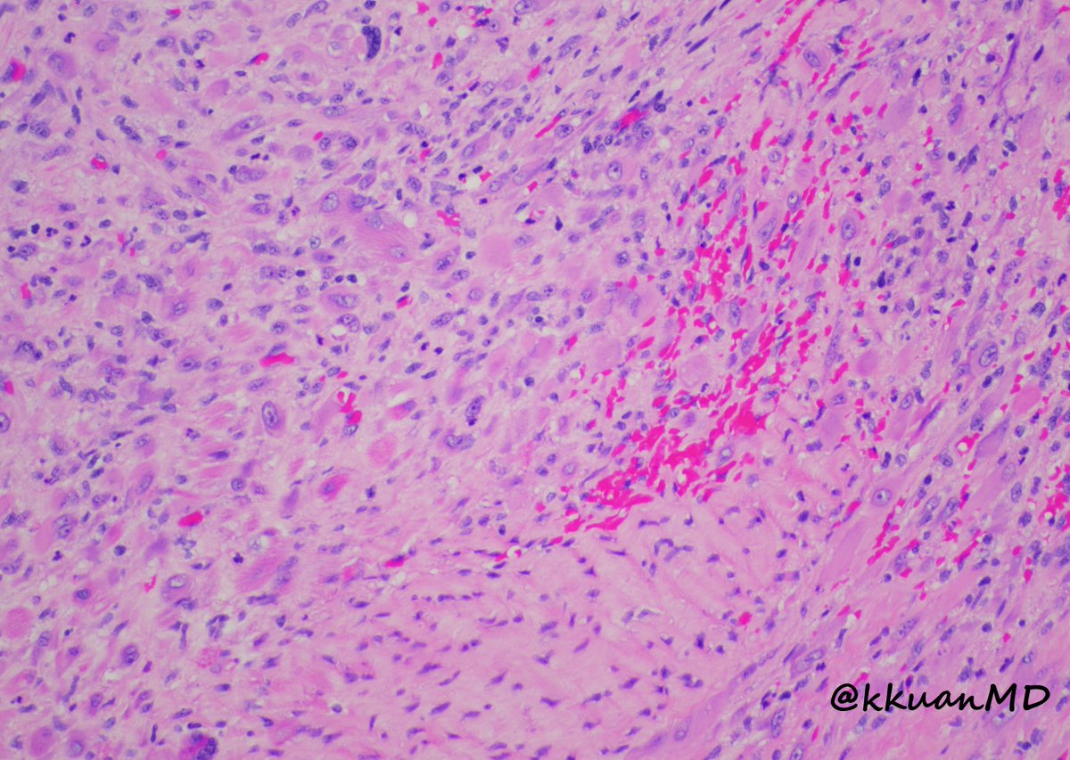 20yo F with right thigh pain for months. Imaging showed 4cm intramuscular lesion, initially thought as vascular malformation. Below is the resection specimen. #pathtwitter #pathology #bstpath #pathboards #patheducation