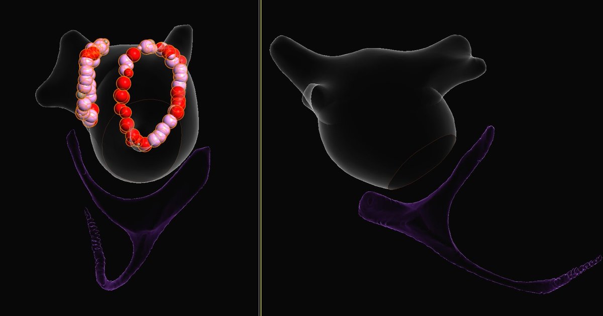 D Randy Jones (@eps_pdx) on Twitter photo Efficient single pass isolation for this paroxysmal #AFib s/p mitral valve replacement. A notably clean surgical LAA resection, unable to visualize on ICE or geometric reconstruction. #AbbottAF @AbbottEP <a href="/TheArtOf_EP/">Stephanie Mitcham</a> Efficient single pass isolation for this paroxysmal #AFib s/p mitral valve replacement. A notably clean surgical LAA resection, unable to visualize on ICE or geometric reconstruction. #AbbottAF @AbbottEP <a href="/TheArtOf_EP/">Stephanie Mitcham</a>
