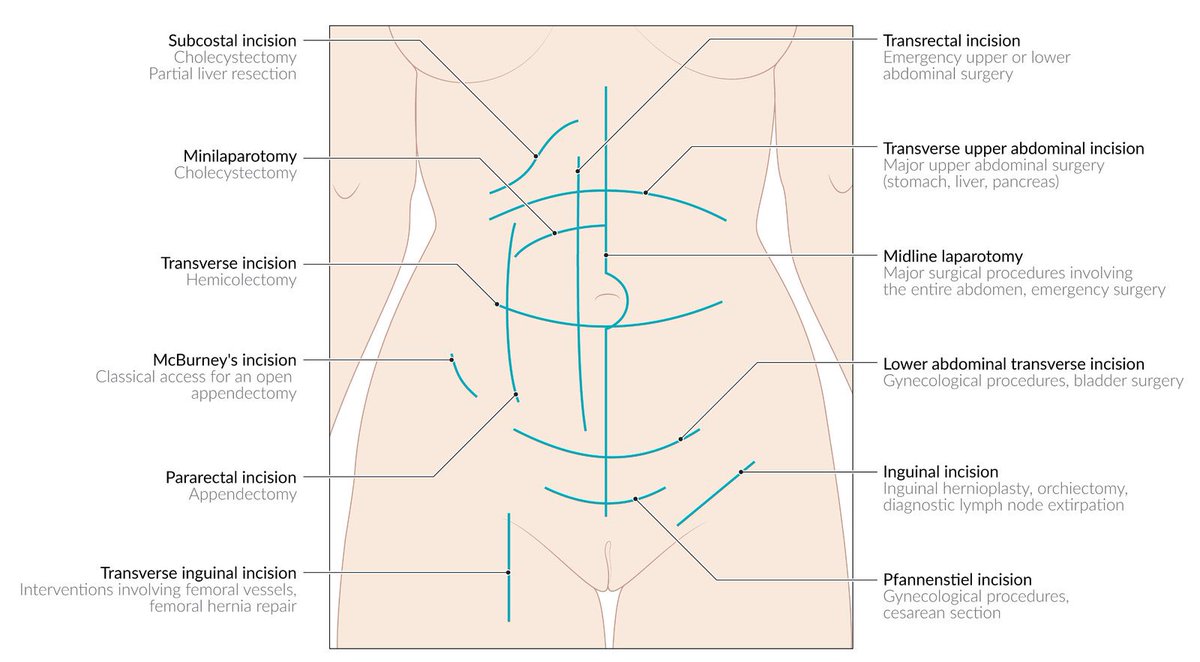 abdominal surgical incisions