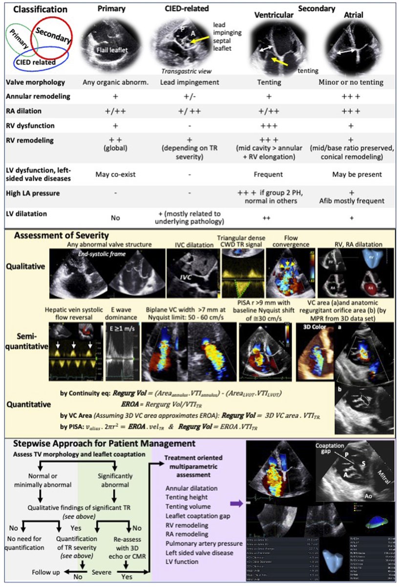 📌How to assess severe tricuspid regurgitation by echocardiography?

📁academic.oup.com/ehjcimaging/ad…
#CardioEd #CardioTwitter #Echofirst