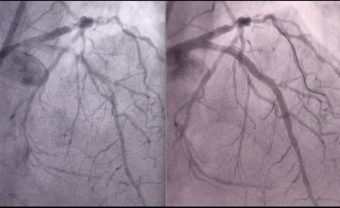 dnzmtlu's tweet image. The first #Rotapro experience in our institution! So proud to be in the Complex CAD team 🙏🏻😎 @CerrahpasaC @iu_cerrahpasa #radialfirst #Cardiology @EAPCIPresident @escardio