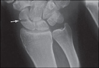 An in-depth review of Scaphoid Fractures.

If you're interested in orthopedics you won't want to miss this review! or fracture...

1/