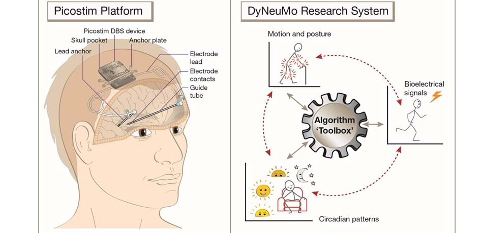 neuromodulate's tweet photo. When what if ? ... becomes what is.
Small, Smart, Closed-Loop Cranialized Picostim 🧠⚡ 'Brain Pacemaker' eliminating need for neck tunnelling to a chest pocket
#imaginethepossibilities #dbs #parkinsons #brainpacemaker #DBS @DBSThinktank @stimbrains
https://t.co/8iaRUI52Re https://t.co/1riktN6BZd
