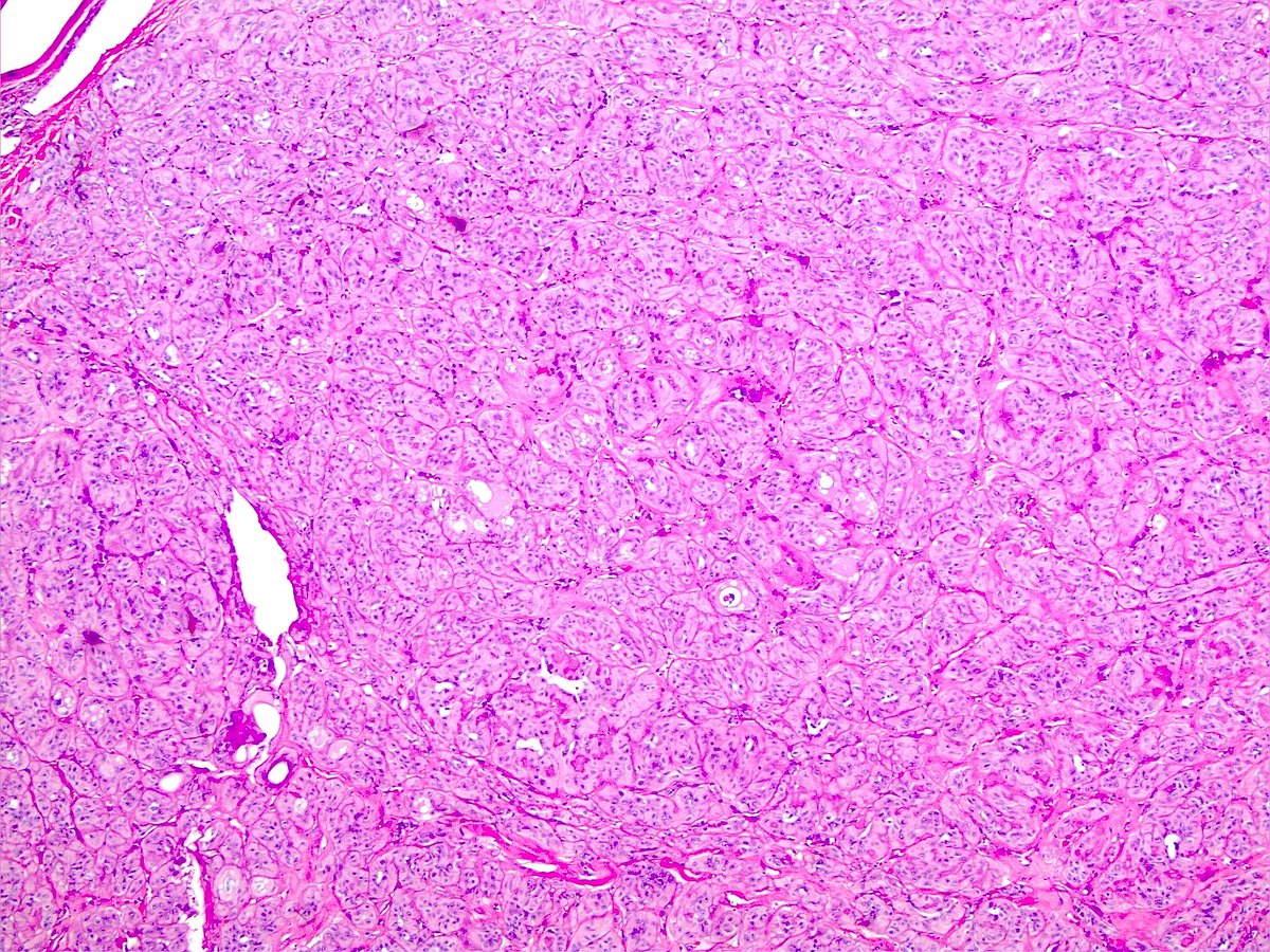 DanielR73682722's tweet photo. What is this lesion from the thyroid? Thyroglobulin (pictured) patchy positive, synaptophysin and calcitonin negative. #thyroidpathology #neckpathology #PathTwitter https://t.co/5Hu11uTaAX