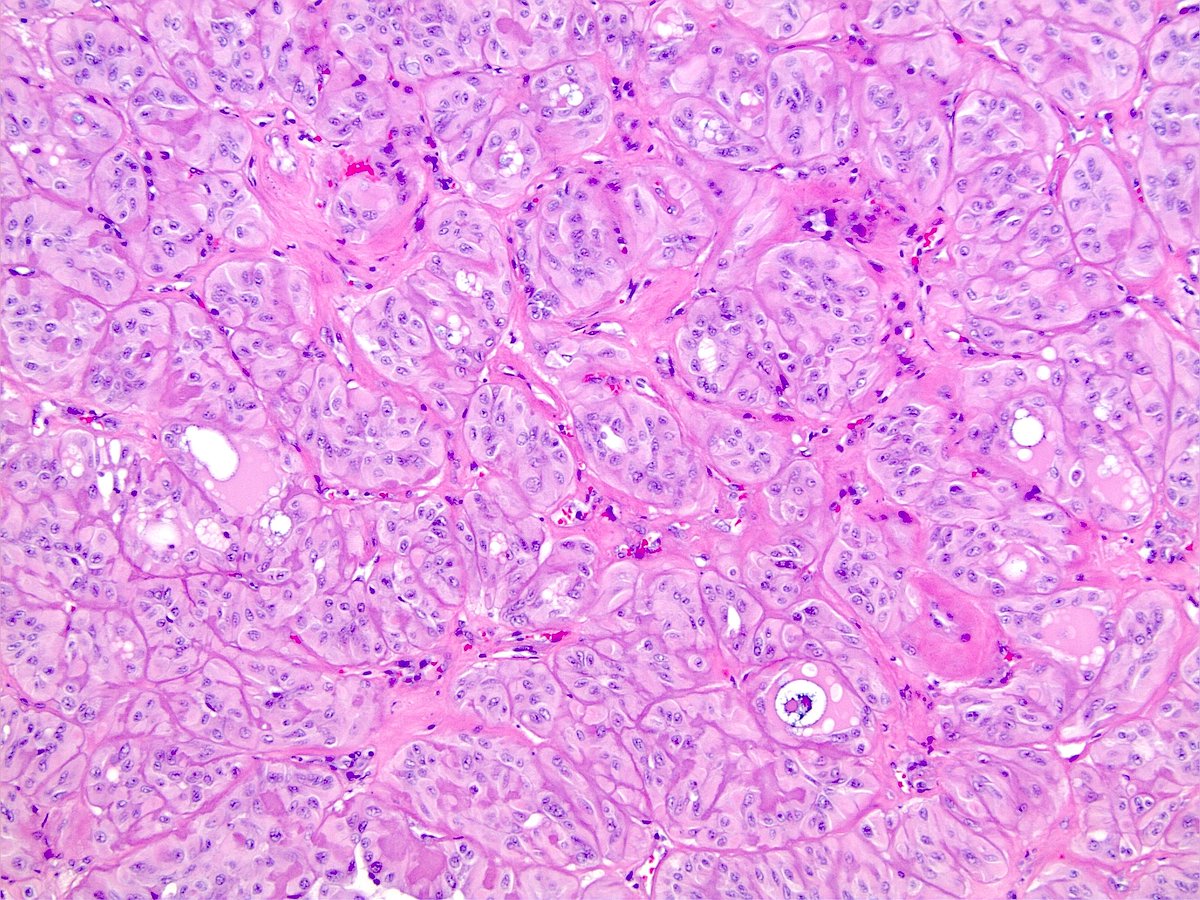 DanielR73682722's tweet photo. What is this lesion from the thyroid? Thyroglobulin (pictured) patchy positive, synaptophysin and calcitonin negative. #thyroidpathology #neckpathology #PathTwitter https://t.co/5Hu11uTaAX