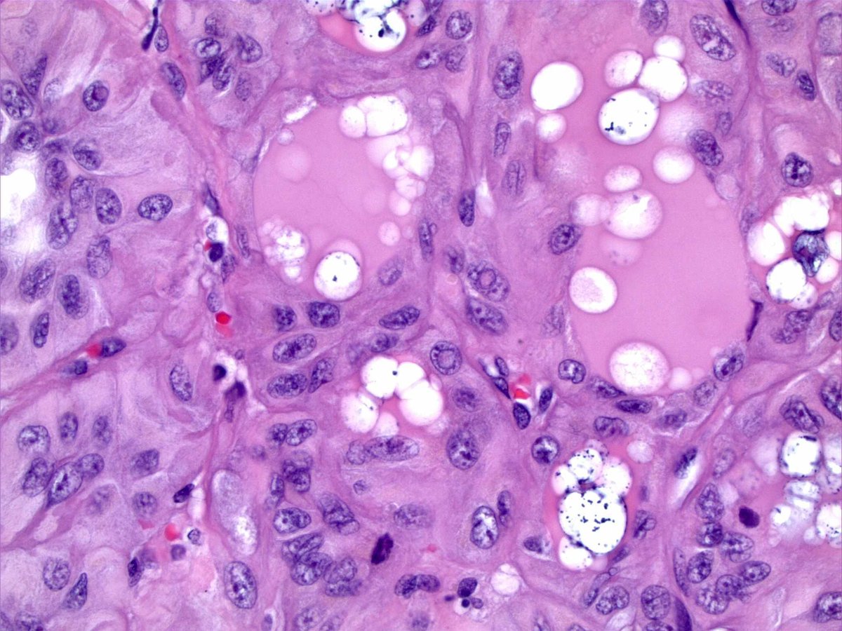 DanielR73682722's tweet photo. What is this lesion from the thyroid? Thyroglobulin (pictured) patchy positive, synaptophysin and calcitonin negative. #thyroidpathology #neckpathology #PathTwitter https://t.co/5Hu11uTaAX