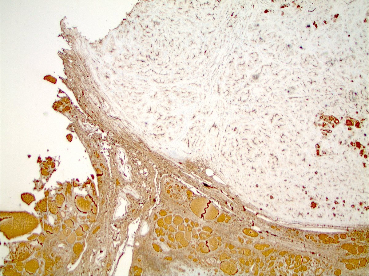 DanielR73682722's tweet photo. What is this lesion from the thyroid? Thyroglobulin (pictured) patchy positive, synaptophysin and calcitonin negative. #thyroidpathology #neckpathology #PathTwitter https://t.co/5Hu11uTaAX