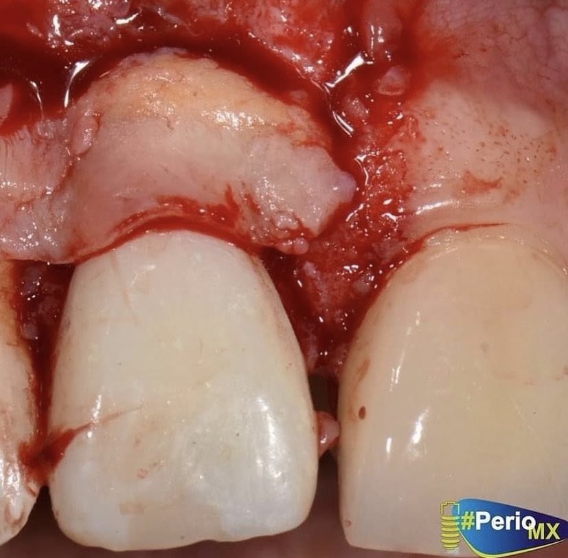 PerioMX's tweet photo. Injertos para aumento de tejido queratinizado y cobertura radicular👇🏽👇🏽👇🏽

#periomxacademy #perioGO #perioMX #odontologiaestetica #periodontology #higiene #Dentist #odontologia https://t.co/8ew4EMSso1