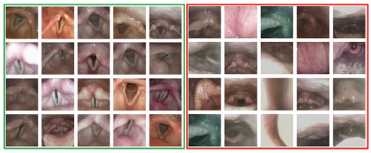 Anaïs Rameau, MD MPhil (@throatbuddha) on Twitter photo Excited to share our collaborative paper with <a href="/ElementoLab/">Olivier Elemento</a> on "automatic classification of informative laryngoscopic images using deep learning" published in LIO bit.ly/3LmLuhK This project was funded by the 2021 American Laryngological Voice and Research Education Grant Excited to share our collaborative paper with <a href="/ElementoLab/">Olivier Elemento</a> on "automatic classification of informative laryngoscopic images using deep learning" published in LIO bit.ly/3LmLuhK This project was funded by the 2021 American Laryngological Voice and Research Education Grant
