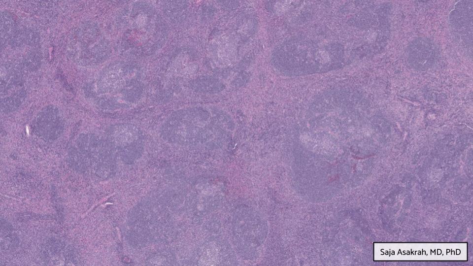 GAPathologists's tweet photo. GAP Case of the Month #6:
62 y/o w/ 2+ years of R facial swelling & mass in the masticator space.
By: Saja Asakrah MD, PhD (@SAsakrah)
π¬ Take a look for yourself (WSI, @pathpresenter): https://t.co/NQ0rf3PBz8
π‘ Check your answer: https://t.co/LjkeoXfQtb
#GAPCoTM #hemepath https://t.co/H34Wkpc07k