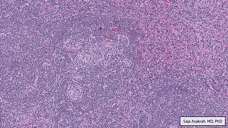 GAPathologists's tweet photo. GAP Case of the Month #6:
62 y/o w/ 2+ years of R facial swelling & mass in the masticator space.
By: Saja Asakrah MD, PhD (@SAsakrah)
π¬ Take a look for yourself (WSI, @pathpresenter): https://t.co/NQ0rf3PBz8
π‘ Check your answer: https://t.co/LjkeoXfQtb
#GAPCoTM #hemepath https://t.co/H34Wkpc07k