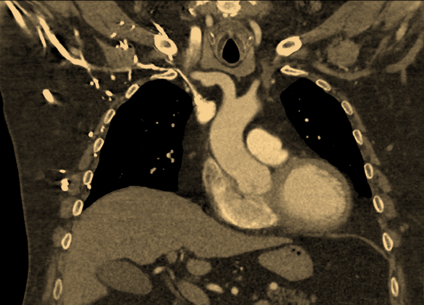 InvasiveCardiol's tweet photo. Patients w/ sinus rhythm &amp; AV block can benefit from single-chamber leadless pacing systems w/ AV synchrony algorithm. Identifying appropriate recipients for this device has become increasingly relevant. Here, an ideal candidate is described https://t.co/1kc47kr7dI https://t.co/S2PdofEV8x
