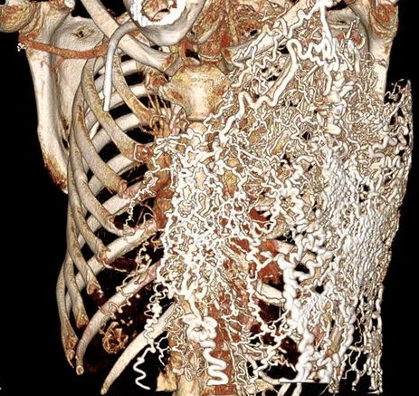#Nephrology #MedEd image of the day: CT scan showing extensive chest wall collaterals in an #ESRD Pt with near-complete occlusion of superior vena cava due to vascular injury from long-term/repeated #dialysis catheters.

From one of our old publications 🔗 link.springer.com/article/10.100…