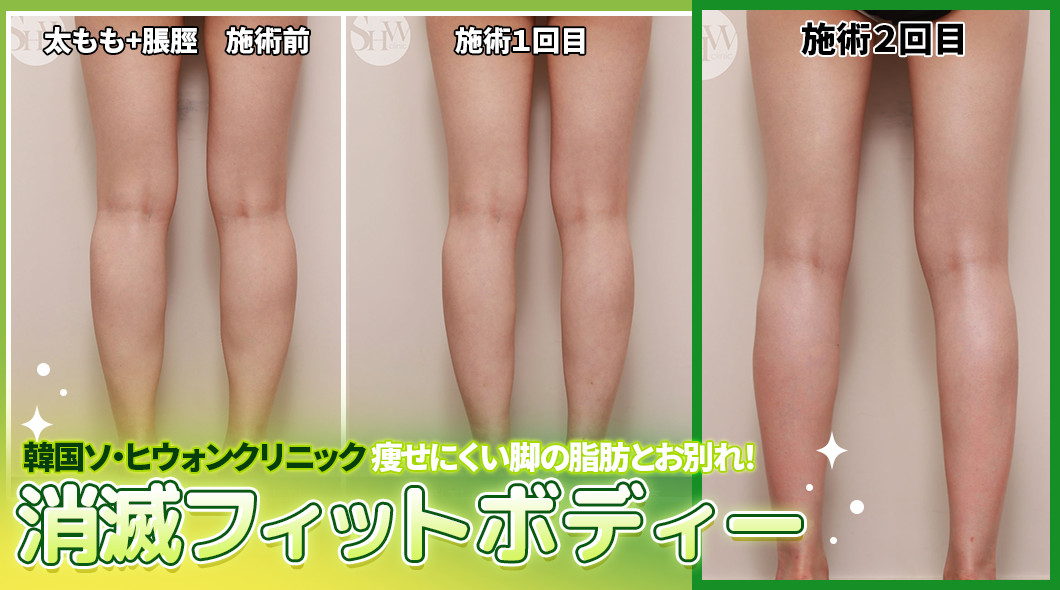 韓国shw ソ ヒウォンクリニック 韓国ソ ヒウォンクリニック 理想的なスラっとした脚をご希望ですか 一人ひとりにカスタムされた脂肪分解で より良い効果の実感をご希望ですか ソ ヒウォンだけの消滅フィットボディー注射で 大変身しちゃいま 韓国shw ソ ヒウォンクリニック 韓国ソ ヒウォンクリニック 理想的なスラっとした脚をご希望ですか 一人ひとりにカスタムされた脂肪分解で より良い効果の実感をご希望ですか ソ ヒウォンだけの消滅フィットボディー注射で 大変身しちゃいま