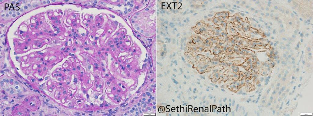 SethiRenalPath's tweet photo. EXT-positive membranous nephropathy (MN), case today. Value of EXT in MN- marker for 1) underlying autoimmune disease, &amp; 2) favorable prognosis. 35-yr woman with nephrotic syndrome and ? lupus. This patient likely has class V lupus MN. https://t.co/4QshCpdKoq https://t.co/bfzq56FNG6