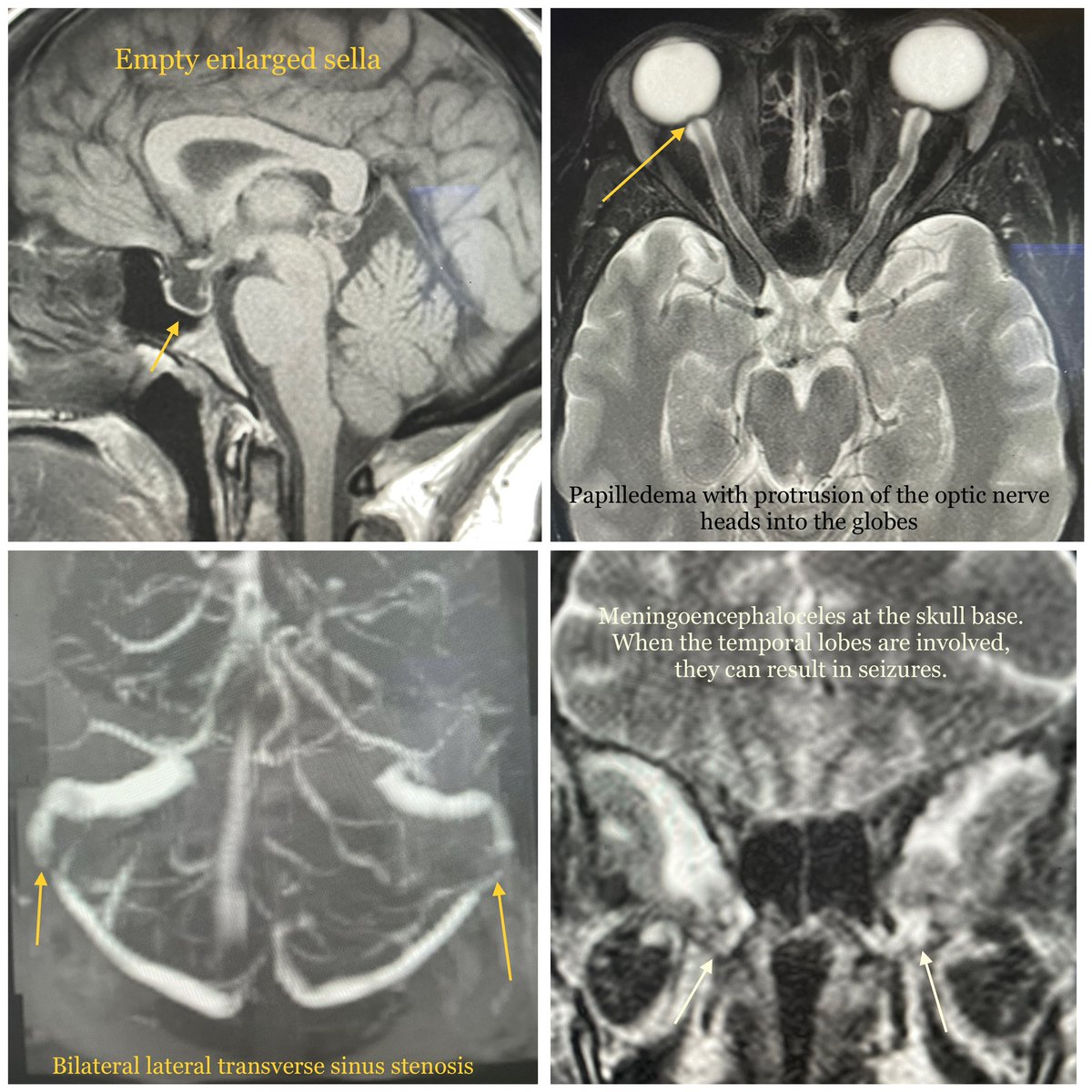 The radiologist may often be the first to diagnose idiopathic intracranial hypertension. Diagnosis can be challenging as these patients can have normal opening pressures. Look for these findings on MRI, which are not always present together. #Neurorad #radres #NeuroTwitter