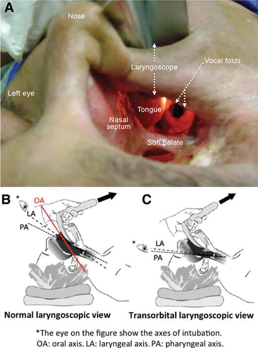AvrahamCooperMD's tweet photo. Transorbital intubation 🤯

https://t.co/fZz5hmFCsZ

#MedTwitter https://t.co/b6eVeHqCp0