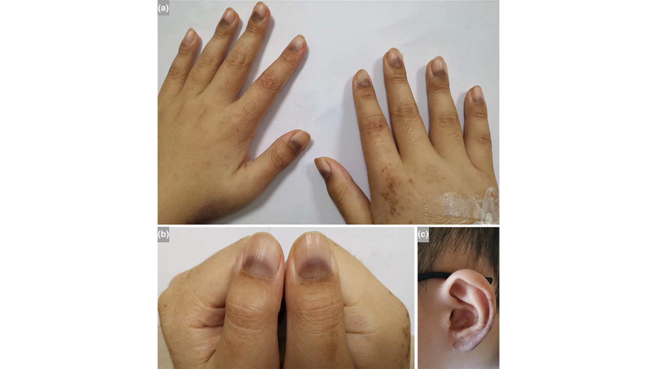 Skin Rash - Symptoms and Treatment | MinuteClinic