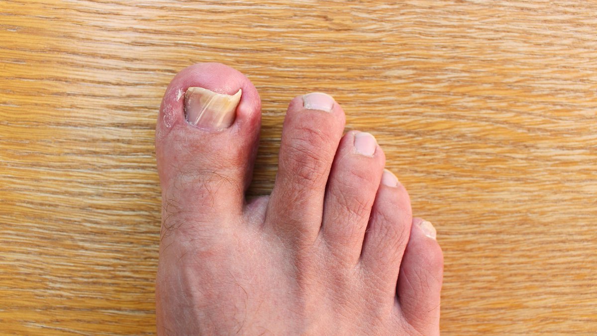 We understand how extremely painful ingrown toenails can become with the swelling and tenderness. Don’t let the pain of ingrown toenails stop you from doing what you like or wearing the shoes you love! idahofoot.com/practice_areas…