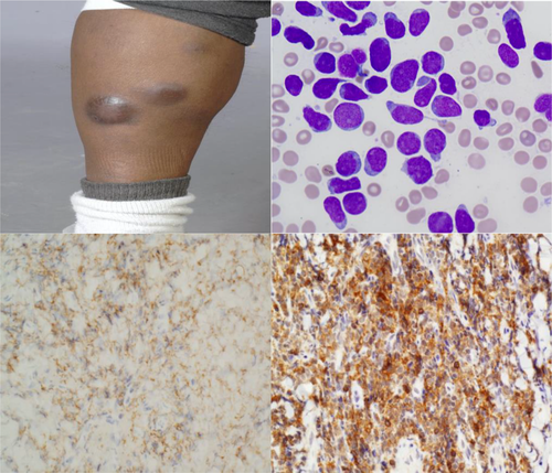 Novel PDGFRA mutation in blastic plasmacytoid dendritic cell neoplasm; possible therapeutic implications onlinelibrary.wiley.com/doi/full/10.11… #BPDCN