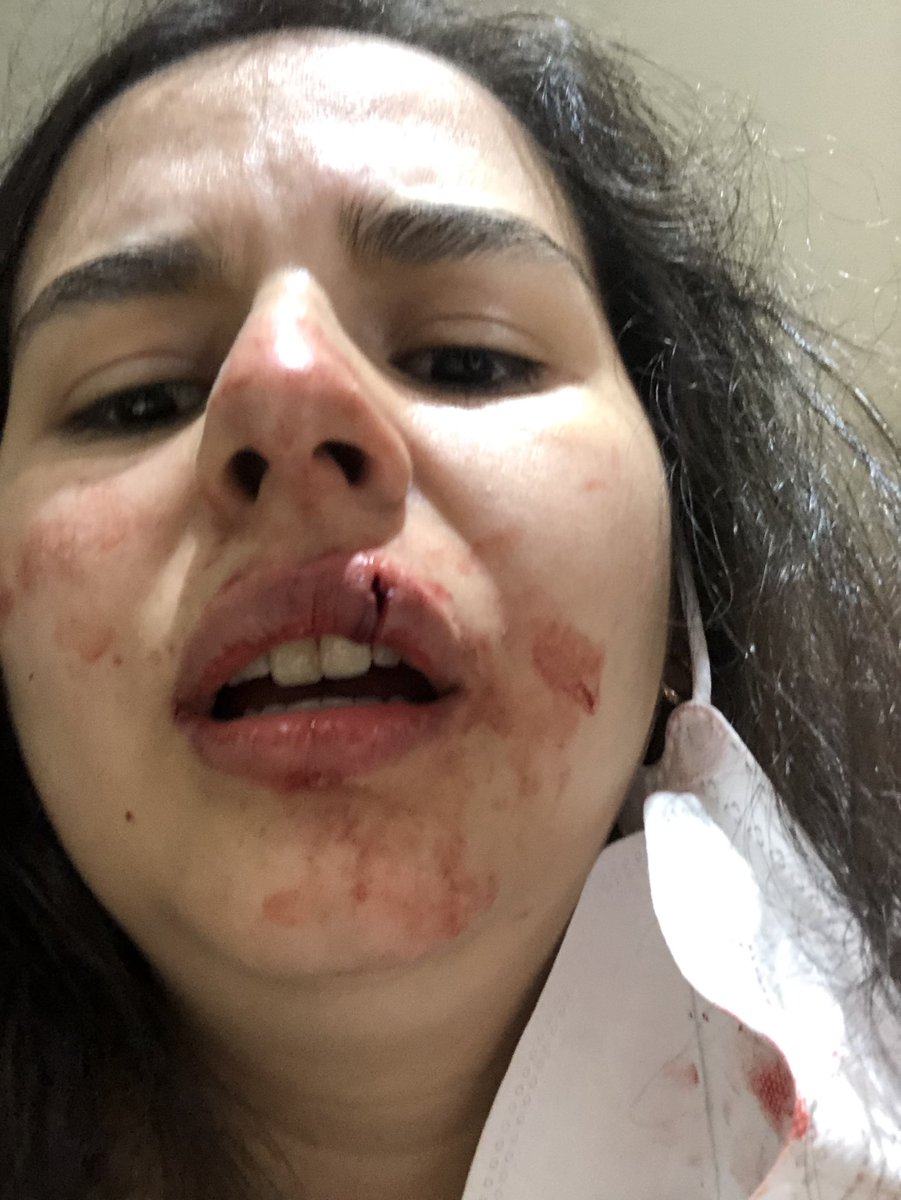 sellocampos's tweet photo. Inaudito. Hoy saliendo a trabajar me topé con Rafaella Chávez Ramírez nada más y nada menos que la hija de @marbelle30 le pedí se pusiera el tapabocas y recibí un golpe que me dejó incapacitada. Quién puede ayudarme? SOS @blueradioco @CaracolNoticias  @NoticiasRCN @BogotaET https://t.co/3mH1wLvZh3