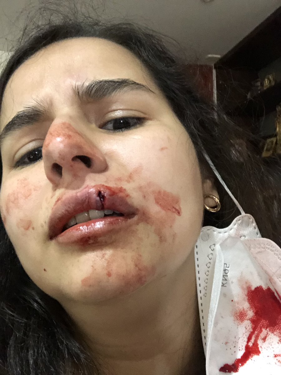 sellocampos's tweet photo. Inaudito. Hoy saliendo a trabajar me topé con Rafaella Chávez Ramírez nada más y nada menos que la hija de @marbelle30 le pedí se pusiera el tapabocas y recibí un golpe que me dejó incapacitada. Quién puede ayudarme? SOS @blueradioco @CaracolNoticias  @NoticiasRCN @BogotaET https://t.co/3mH1wLvZh3