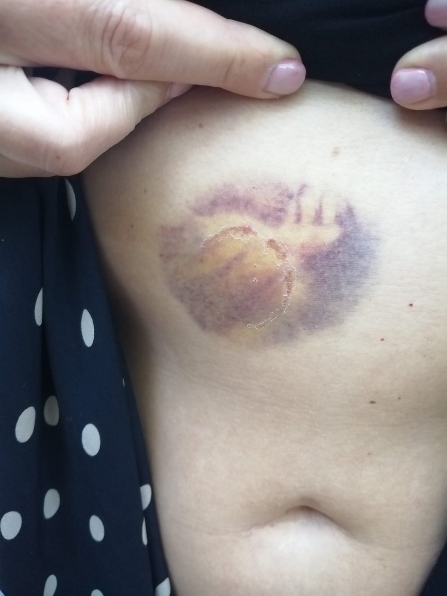 This is my friend <a href="/Abi24353671/">Abi</a>. At the weekend she was assaulted by a security guard working at the <a href="/royaltonnegril/">Royalton Negril</a> Hotel in front of witness &amp; CCTV. He's falsely accused her of punching him, so now she's had her passport removed, due to appear in court on 23/2...