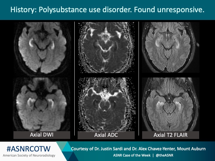 The American Society of Neuroradiology tweet media