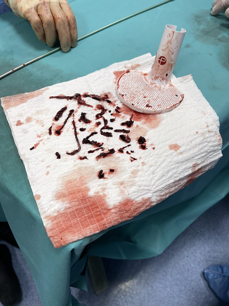 ElwerEng's tweet photo. First PE case in Saudi Arabia using #lightening12   with new engine done by our hero doctor AbdulRahman Alvi in NGH /Riyadh
Penumbra, Inc. https://t.co/c2c5Q3U83N