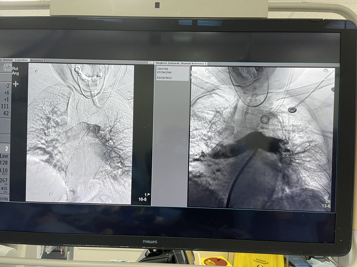 ElwerEng's tweet photo. First PE case in Saudi Arabia using #lightening12   with new engine done by our hero doctor AbdulRahman Alvi in NGH /Riyadh
Penumbra, Inc. https://t.co/c2c5Q3U83N