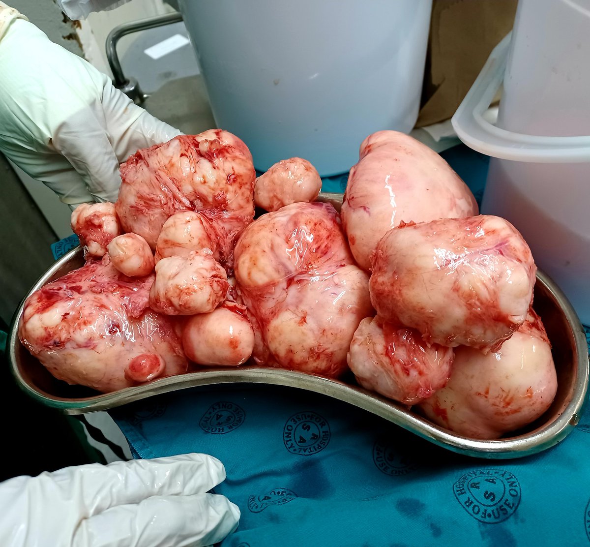 DrBenjii's tweet photo. :: I performed my first myomectomy, 16 Fibroids removed 🙏🏽 https://t.co/QcbgoOmbNH