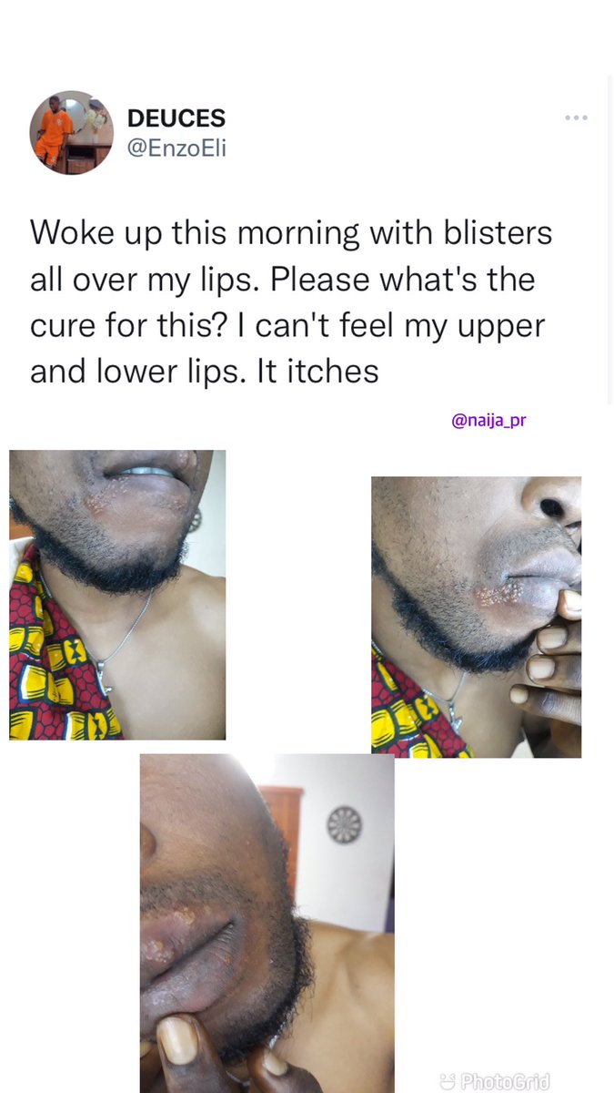 Naija_PR's tweet photo. Man raises alarm after waking up with blisters around his mouth👀 https://t.co/OTlTAU9TgR