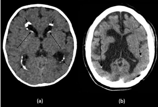 En este mini-hilo os traemos una revisión del 2019 sobre las calificaciones intracraneales visualizadas en TC craneal. 

A pesar del creciente uso de la RM en los últimos años, el TC continúa siendo la prueba diagnóstica más sensible para la detección de las mismas.