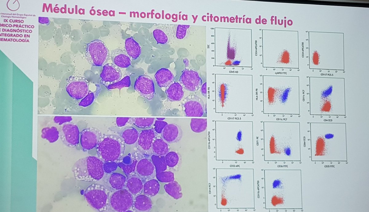 GHematologica's tweet photo. Empezamos con la 1ra sesión de casos clínicos en la Reunion interanual del #GECH! https://t.co/O1VlNhIXvF